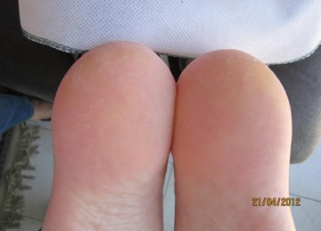 פדיקור לחולי סוכרת